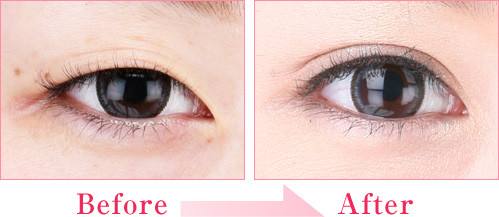 濟(jì)南哪家醫(yī)院做細(xì)胞填充鼻唇溝效果好？