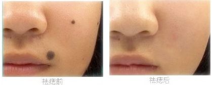 合肥祛斑醫(yī)院那家好？專家推薦的治療祛斑醫(yī)院大盤點(diǎn)