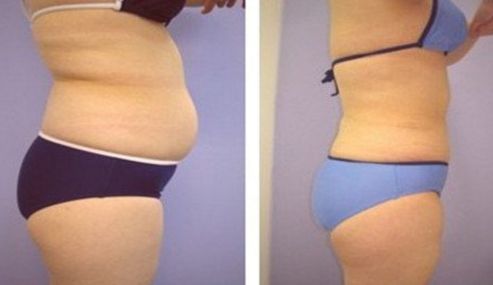 寧波做吸脂醫(yī)院推薦頂級整形醫(yī)院綜合排名