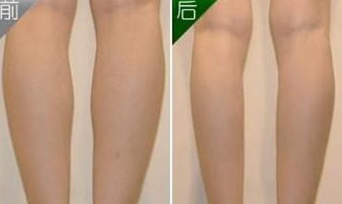 沈陽哪家醫(yī)院做眼角整形效果好且價格合理？