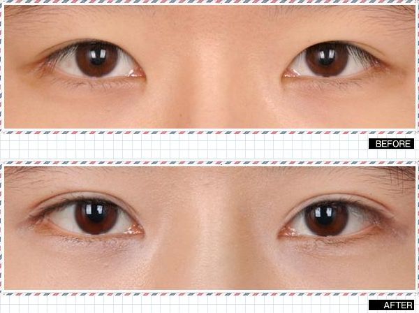 大連有哪些專業(yè)的祛眼袋醫(yī)院？從專業(yè)角度分析大連祛眼袋哪家醫(yī)院好