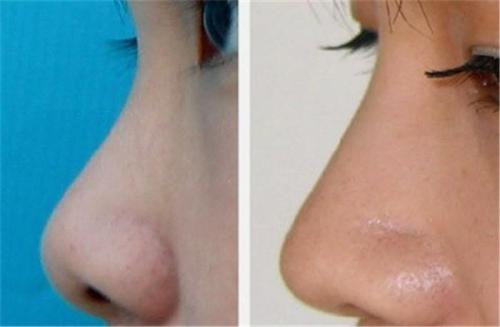 蘇州哪家醫(yī)院的耳矯正效果好？2023年最新排名來(lái)啦！