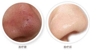 眼袋問題煩惱你？超聲波能治愈嗎？