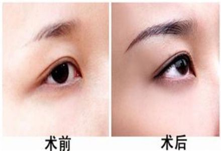 該癥狀是否需要修正？鼻子肥大修正的后果如何呢？