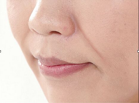 雙眼皮的優(yōu)缺點及適合人群有哪些