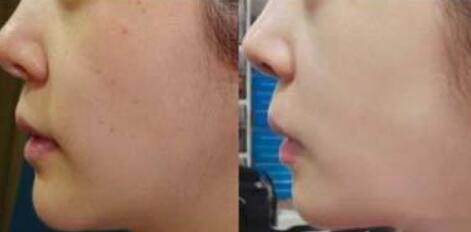 去除魚尾紋手術(shù)需要哪種方法？術(shù)后護(hù)理要點(diǎn)是什么？費(fèi)用一般是多少？