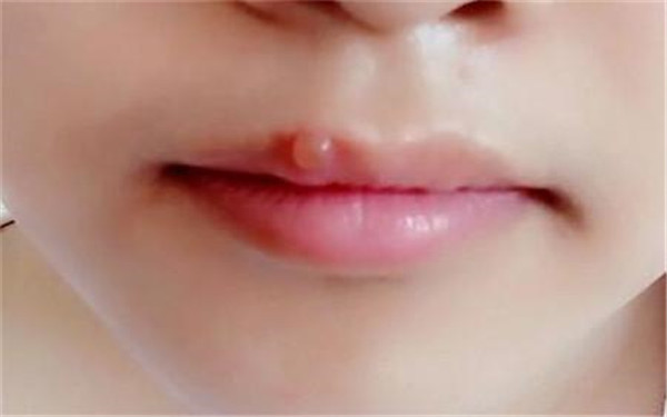 昆明哪家醫(yī)院的玻尿酸豐面頰整形效果比較好？不同醫(yī)院的技術(shù)優(yōu)勢(shì)有何不同？