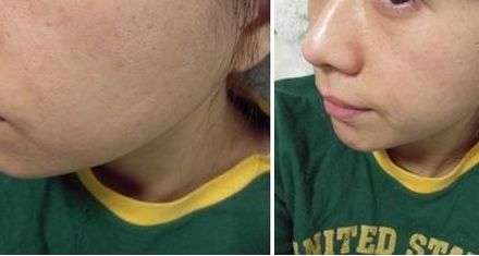 北京整形醫(yī)院吸脂效果怎么樣？