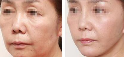 如何選擇眼睛還是面部進行吸脂手術(shù)？