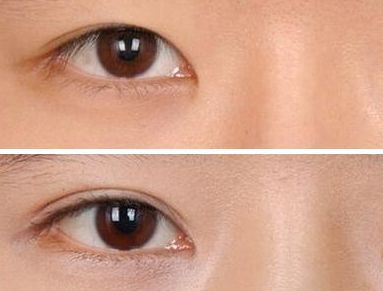 上海比較權(quán)威的去眼袋整形醫(yī)院推薦，專業(yè)選優(yōu)、信譽口碑集聚，公立私立任您挑選！