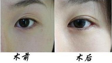 汕頭做光子嫩膚醫(yī)院哪家好？選擇最適合您的汕頭美容醫(yī)院