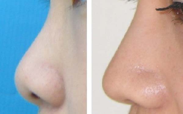 杭州重瞼術醫(yī)院2023前10強排行榜公布，切開法手術哪家好