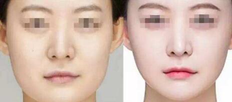 oe光子嫩膚到底值不值？價格合理嗎？