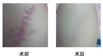 寧波去妊娠紋手術(shù)前10家醫(yī)院推薦！2023年光子整形醫(yī)院排行榜出爐！