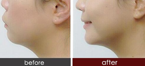 2023年浙江雙眼皮醫(yī)院排名榜出爐，哪家受歡迎？