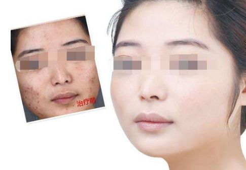 重慶雙眼皮術(shù)口碑極佳醫(yī)院， 塑造閃耀魅眼！