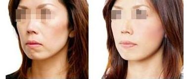 葫蘆島光學(xué)洗紋身醫(yī)院口碑排名TOP10大揭秘！