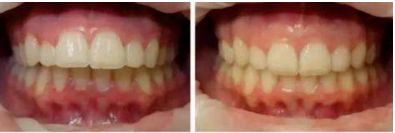 泉州那位醫(yī)生擅長Invisalign隱適美和時(shí)代天使認(rèn)證？