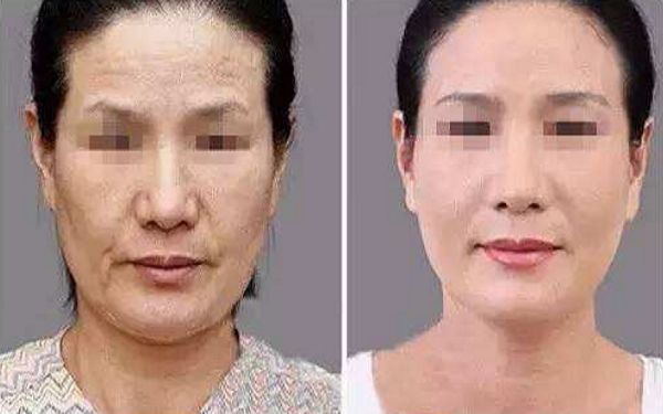 武漢頸部皺紋微針填充醫(yī)院排名及口碑評(píng)價(jià)TOP10盤點(diǎn)！