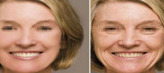 武漢注射豐唇玻尿酸哪家醫(yī)院好？排名前10強(qiáng)揭秘！