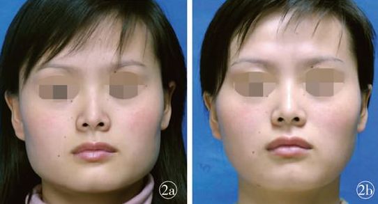 煙臺眼部微針祛皺醫(yī)院排名前10！