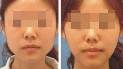 武漢祛法令紋手術(shù)醫(yī)院口碑排行榜