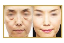 柳州靜態(tài)紋激光祛除，專家推薦的醫(yī)療整形醫(yī)院排名前10