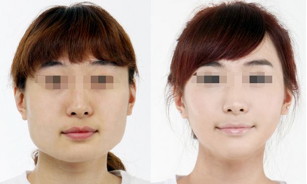 上海哪家醫(yī)院做隆鼻好