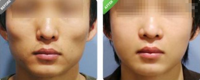 了解有效而安全的方式，改善鼻型：隆鼻術(shù)前考慮及手術(shù)后常見問題—全面指南