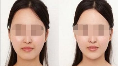 湖南黃金微雕去皺排名前10醫(yī)院大揭秘！