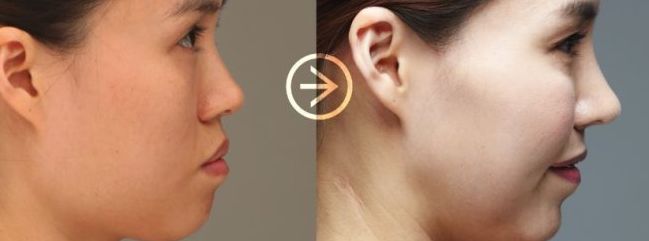 中山眼瞼凹陷填充正規(guī)醫(yī)院排行榜：十佳機(jī)構(gòu)效果點(diǎn)評