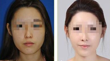 協(xié)和醫(yī)院張海林隆鼻效果評(píng)價(jià)