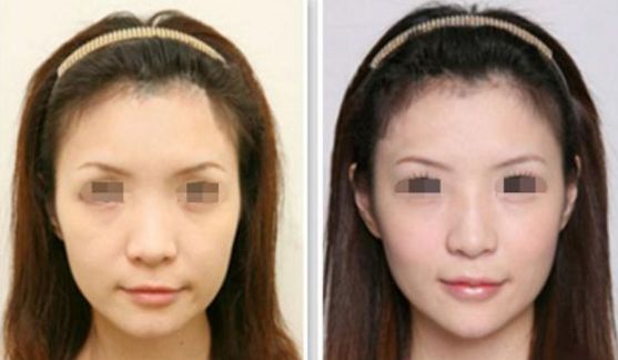 南京額頭皺紋激光祛除醫(yī)院專業(yè)實力排行