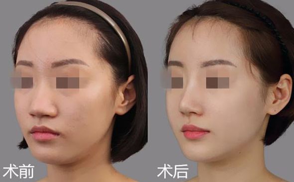 保定祛痘疤口碑前十整形醫(yī)院排名及價(jià)格對(duì)比