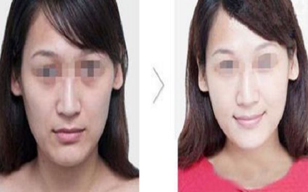 鄭州雀斑治療醫(yī)院排行榜更新！解放雀斑困擾，顏值重回巔峰