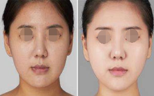 深圳鼻部脂肪填充美容機構排行榜：前10強連鎖名單揭秘！