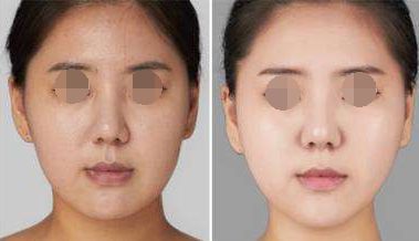 成都銅雀臺隆鼻口碑如何？聽聽用戶怎么說