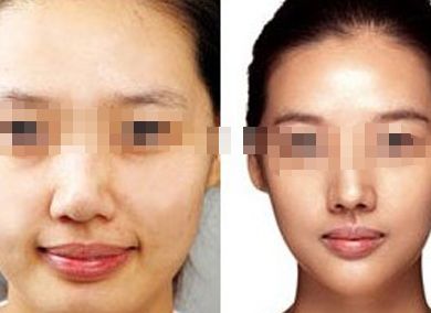 南京點陣激光去唇紋達人親推：口碑好的整形醫(yī)院Top10