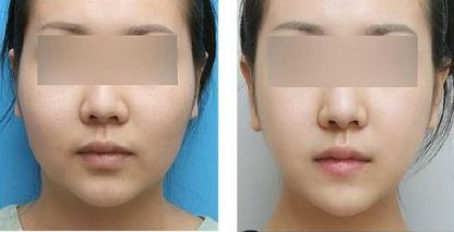 南京FUP微創(chuàng)多點面部提升術(shù)前10大醫(yī)院排行榜公布！