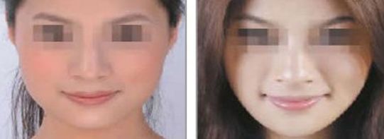 術后隆鼻假體護理攻略：如何有效照顧術后鼻部假體？