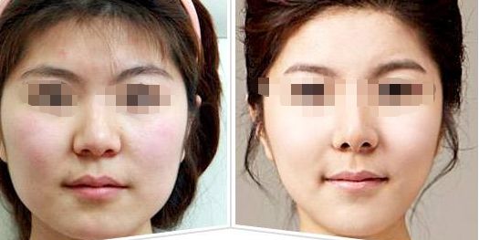 汕頭市中心醫(yī)院汕頭脂肪隆鼻專業(yè)醫(yī)療團隊豐富，權威細節(jié)請點擊！