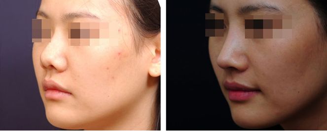 鄭州超皮秒去紋身靠譜醫(yī)院前十評鑒！權(quán)威指南助你煥顏重生