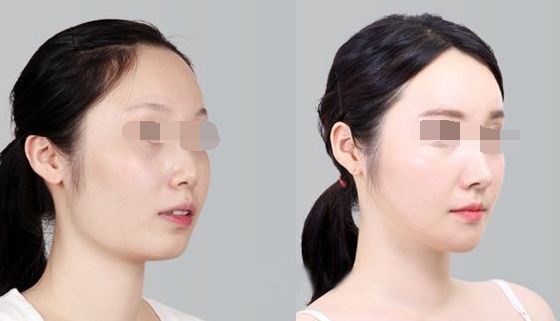 中山專業(yè)祛魚(yú)尾紋醫(yī)院排行榜TOP10，魚(yú)尾紋去除不再愁！