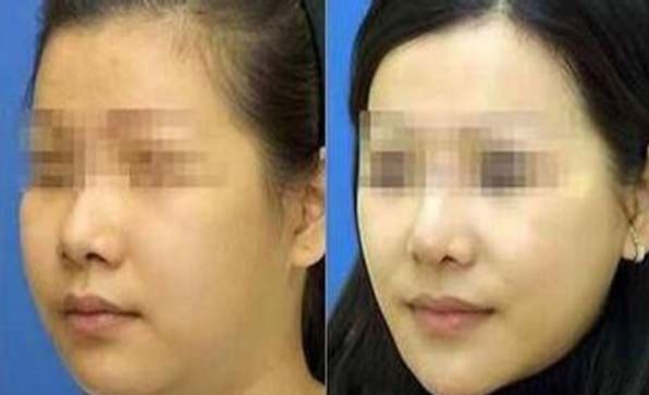 合肥哪家醫(yī)院能有效去除抬頭紋？推薦前10強(qiáng)