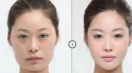 運城：上眼瞼嗨體填充，哪家整形醫(yī)院值得信賴？