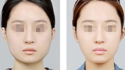 赤峰抬頭紋填充玻尿酸醫(yī)院排名前十！