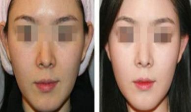 菏澤哪里能找到靠譜的隆鼻醫(yī)院