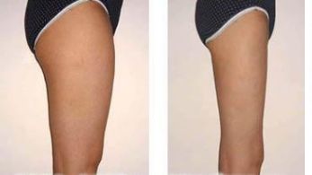 西安哪家整容醫(yī)院的隆鼻效果比較好呢？