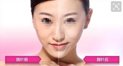 天津自體脂肪豐臀醫(yī)院實力排名及介紹