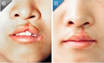 邢臺尚美醫(yī)療美容：專業(yè)的脂肪隆鼻醫(yī)院服務詳解！